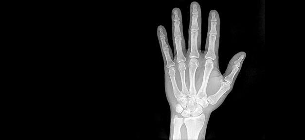 Verfassungsbeschwerde gegen umstrittene Altersbestimmung bei unbegleiteten Flüchtlingen röntgen, x-ray, hand, gesundheit, medizin, untersuchung